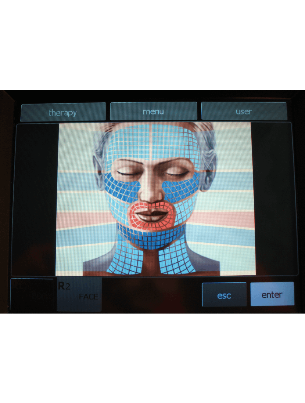 2011 BTL Exilis RF Wrinkle Tightening /w XP 2 & Large Handpieces BTL