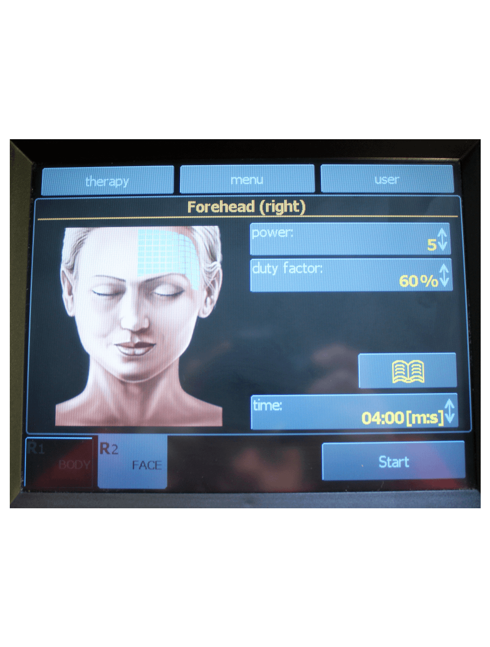 2011 BTL Exilis RF Wrinkle Tightening /w XP 2 & Large Handpieces BTL
