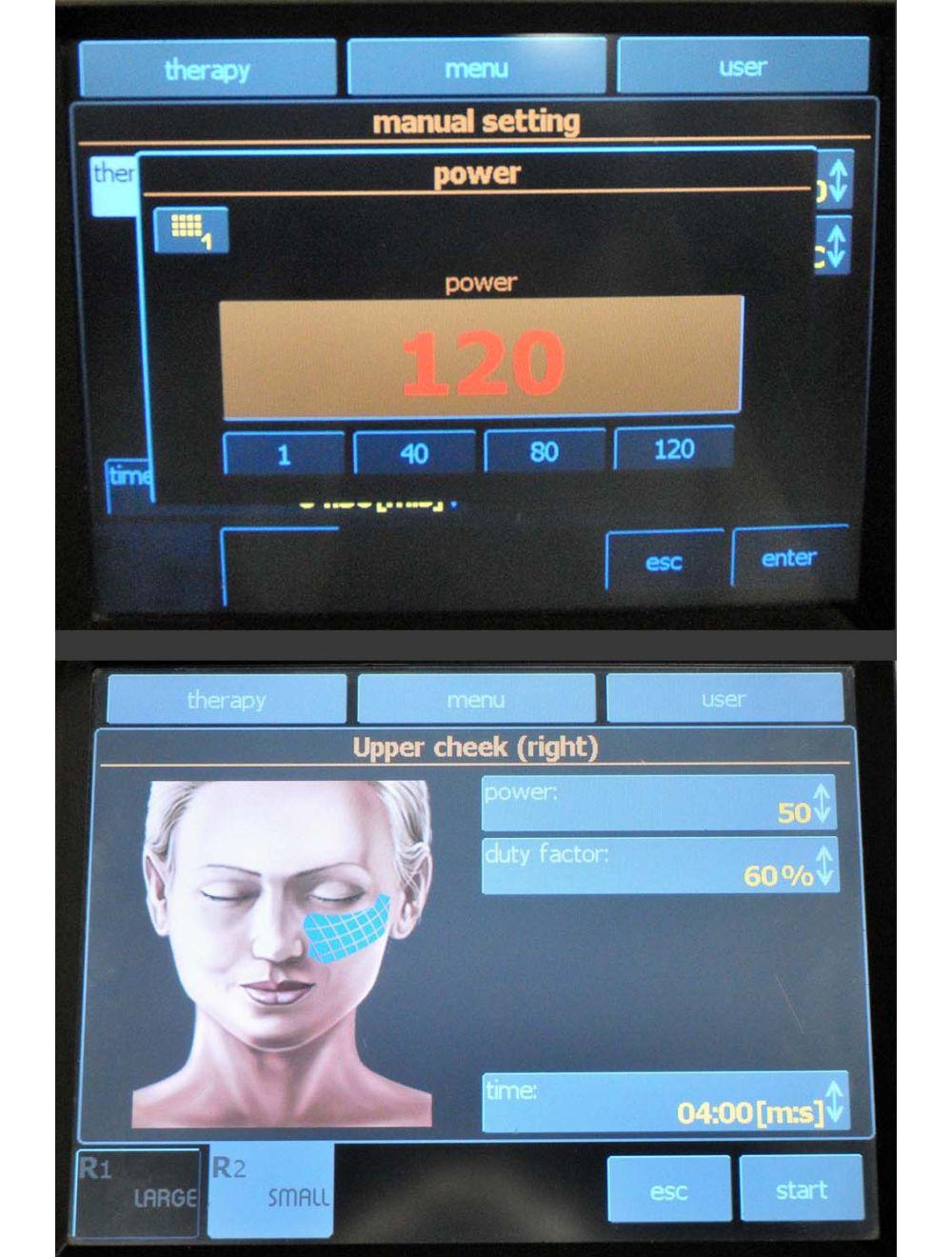 2011 BTL Exilis Elite Radio Frequency 120 Watt Laser Body Shape Skin Tightening BTL