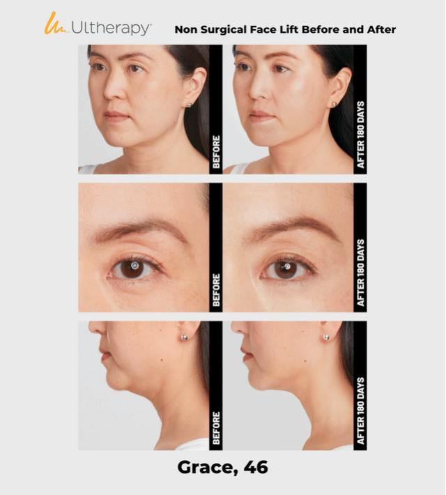 Ulthera Ultherapy DeepSee Transducer DS 10-1.5 (Orange) image 6